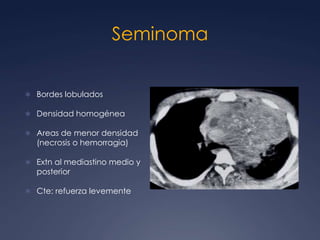 Células primitivas mal depositadas