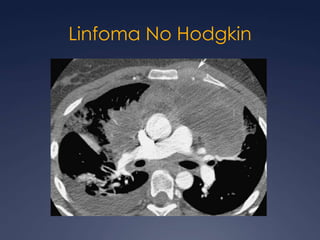 Del seno endodérmico 