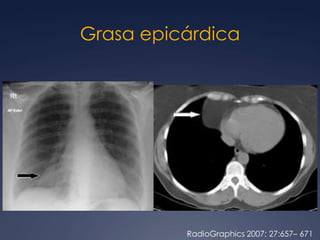 germinal mixtoTumores germinalesBrant and Helms:  389-416