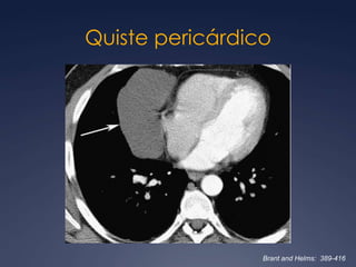Teratoma maduro75 % de los tumores germinales