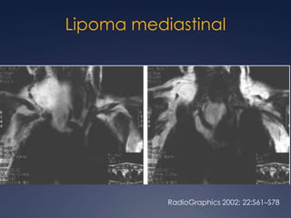 Areas focales sólidas: grasa, dientes, pelos