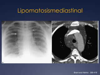 Componente quístico multilocularRadioGraphics 2002; 22:S61–S78