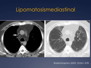 Teratoma maduroRadioGraphics 2004; 24:387– 404