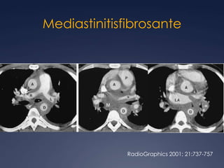 Teratoma inmaduroRadioGraphics 2004; 24:387– 404
