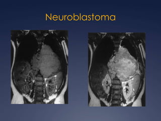 Altamente malignos No sensibles a la radioterapiaSind. Klinefelter 20%Ca. embrionario, tumor  del seno endodérmico, coriocarcinoma o mixtosSintomáticos 90 – 100%MetástasisNo seminomatosos