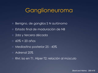 No seminomatosoRadioGraphics 2004; 24:387– 404