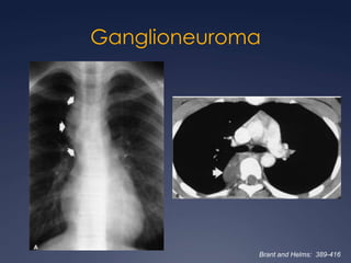 LinfomaNeoplasia mediastinal más frecuente en adultosLH: 85% tórax90% adenomegalias mediastinales.LNH: 50% mediastino (linfoma linfoblástico y linfoma de células B grandes)Brant and Helms:  389-416