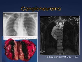 Linfoma de HodgkinCLÁSICAEsclerosis nodular  Celularidad mixtaRico en linfocitosDepleción linfocitariaNO CLÁSICANodular de predominio linfociticoBrant and Helms:  389-416
