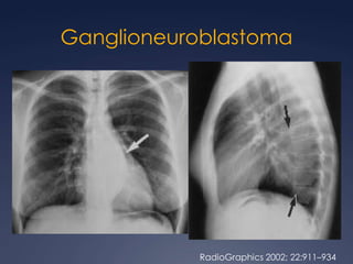 Mediastino Anterior 90%