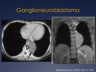 Confinado solo a M.Anterior, únicamente 40%