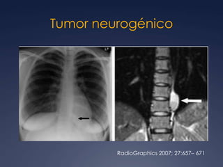 A veces hipodensas por necrosis