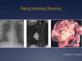 Calcificadas después de tratamientoLinfoma de Hodgkin