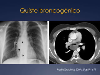 LinfomaRadioGraphics 2007; 27:657– 671