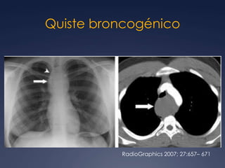 Generalmente isodensos al músculo en CTNecrosis y calcio en postquimioterapiaHiperintensos T2 RMPET/CT tamaño normal pero actividad metabólicaLinfoma No Hodgkin