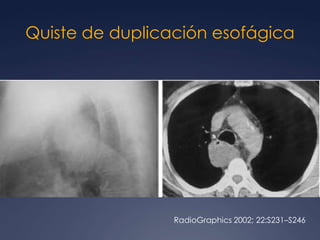 Grasa epicárdicaRadioGraphics 2007; 27:657– 671