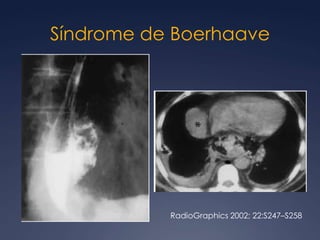 Quiste pericárdicoBrant and Helms:  389-416