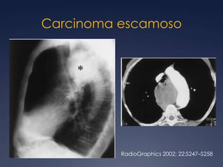 Mediastinitis esclerosanteBrant and Helms:  389-416