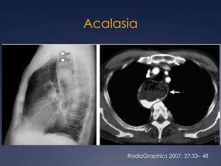 Hemangioma mediastinalRadioGraphics 2002; 22:S231–S246
