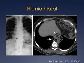 Lipoma mediastinalRadioGraphics 2002; 22:S61–S78