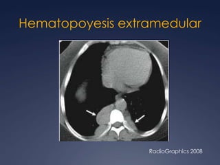 LipomatosismediastinalBrant and Helms:  389-416