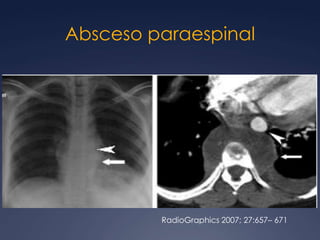 LipomatosismediastinalRadioGraphics 2002; 22:S61–S78