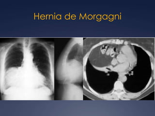 Mediastinitisfibrosante