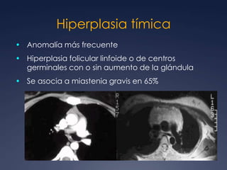 Hiperplasia tímicaAnomalía más frecuente