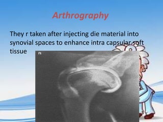 Arthrography
They r taken after injecting die material into
synovial spaces to enhance intra capsular soft
tissue

 