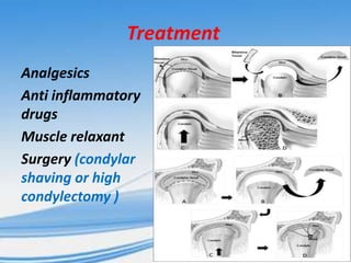 Treatment
Analgesics
Anti inflammatory
drugs
Muscle relaxant
Surgery (condylar
shaving or high
condylectomy )

 