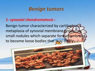 Benign tumors
1- synovial chondromatosis :
Benign tumor characterized by cartilaginous
metaplasia of synovial membrane producing
small nodules which separate form membrane
to become loose bodies that may ossify

 