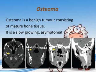 Osteoma
Osteoma is a benign tumour consisting
of mature bone tissue.
It is a slow growing, asymptomatic

 