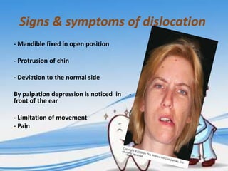 Signs & symptoms of dislocation
- Mandible fixed in open position

- Protrusion of chin
- Deviation to the normal side
By palpation depression is noticed in
front of the ear
- Limitation of movement
- Pain

-

 