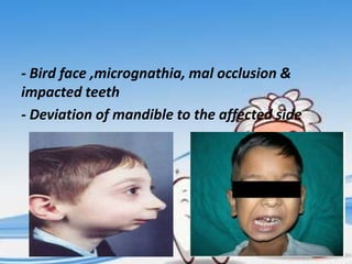 - Bird face ,micrognathia, mal occlusion &
impacted teeth
- Deviation of mandible to the affected side

 