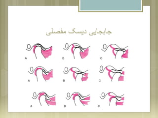 ‫مفصلی‬ ‫دیسک‬ ‫جابجایی‬
 