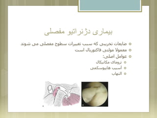 ‫مفصلی‬ ‫دژنراتیو‬ ‫بیماری‬
‫ش‬ ‫می‬ ‫مفصلی‬ ‫سطوح‬ ‫تغییرات‬ ‫سبب‬ ‫که‬ ‫تخریبی‬ ‫ضایعات‬‫وند‬
‫است‬ ‫فاکتوریال‬ ‫مولتی‬ ‫معموال‬
‫اصلی‬ ‫عوامل‬:
‫مکانیکال‬ ‫ترومای‬
‫هایپوسکمی‬ ‫آسیب‬
‫التهاب‬
 