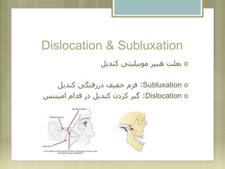 Dislocation & Subluxation
‫کندیل‬ ‫موبیلیتی‬ ‫هیپر‬ ‫بعلت‬
Subluxation:‫کندیل‬ ‫دررفتگی‬ ‫خفیف‬ ‫فرم‬
Dislocation:‫امیننس‬ ‫قدام‬ ‫در‬ ‫کندیل‬ ‫کردن‬ ‫گیر‬
 