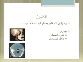 ‫انکیلوز‬
‫نیستند‬ ‫دهان‬ ‫کردن‬ ‫باز‬ ‫به‬ ‫قادر‬ ‫که‬ ‫بیمارانی‬
‫دوفرم‬:
‫کپسولی‬ ‫خارج‬
‫کپسولی‬ ‫داخل‬
 