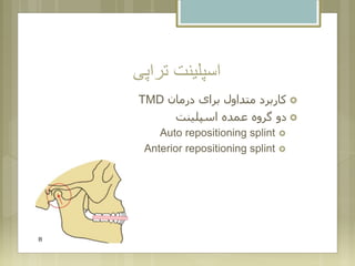 ‫تراپی‬ ‫اسپلینت‬
‫درمان‬ ‫برای‬ ‫متداول‬ ‫کاربرد‬TMD
‫اسپلینت‬ ‫عمده‬ ‫گروه‬ ‫دو‬
Auto repositioning splint
Anterior repositioning splint
 