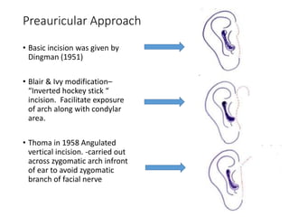 Preauricular Incision Steps Surgical Anatomy of Temporomandibular Joint | PPTX
