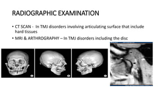 RADIOGRAPHIC EXAMINATION
• CT SCAN - In TMJ disorders involving articulating surface that include
hard tissues
• MRI & ARTHROGRAPHY – In TMJ disorders including the disc
 