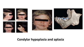 Condylar hypoplasia and aplasia
 