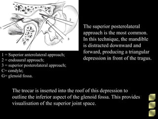 1 = Superior anterolateral approach;
2 = endoaural approach;
3 = superior posterolateral approach;
C= condyle;
G= glenoid fossa.
The superior posterolateral
approach is the most common.
In this technique, the mandible
is distracted downward and
forward, producing a triangular
depression in front of the tragus.
The trocar is inserted into the roof of this depression to
outline the inferior aspect of the glenoid fossa. This provides
visualisation of the superior joint space.
 