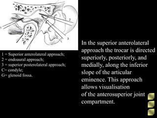 1 = Superior anterolateral approach;
2 = endoaural approach;
3 = superior posterolateral approach;
C= condyle;
G= glenoid fossa.
In the superior anterolateral
approach the trocar is directed
superiorly, posteriorly, and
medially, along the inferior
slope of the articular
eminence. This approach
allows visualisation
of the anterosuperior joint
compartment.
 