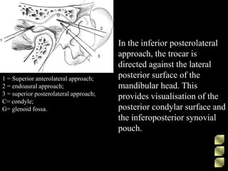 1 = Superior anterolateral approach;
2 = endoaural approach;
3 = superior posterolateral approach;
C= condyle;
G= glenoid fossa.
In the inferior posterolateral
approach, the trocar is
directed against the lateral
posterior surface of the
mandibular head. This
provides visualisation of the
posterior condylar surface and
the inferoposterior synovial
pouch.
 