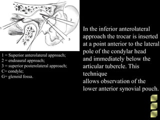 1 = Superior anterolateral approach;
2 = endoaural approach;
3 = superior posterolateral approach;
C= condyle;
G= glenoid fossa.
In the inferior anterolateral
approach the trocar is inserted
at a point anterior to the lateral
pole of the condylar head
and immediately below the
articular tubercle. This
technique
allows observation of the
lower anterior synovial pouch.
 