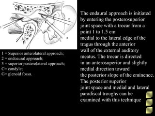 1 = Superior anterolateral approach;
2 = endoaural approach;
3 = superior posterolateral approach;
C= condyle;
G= glenoid fossa.
The endaural approach is initiated
by entering the posterosuperior
joint space with a trocar from a
point 1 to 1.5 cm
medial to the lateral edge of the
tragus through the anterior
wall of the external auditory
meatus. The trocar is directed
in an anterosuperior and slightly
medial direction toward
the posterior slope of the eminence.
The posterior superior
joint space and medial and lateral
paradiscal troughs can be
examined with this technique
 