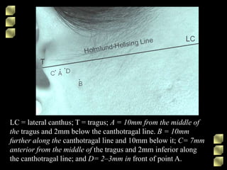 LC = lateral canthus; T = tragus; A = 10mm from the middle of
the tragus and 2mm below the canthotragal line. B = 10mm
further along the canthotragal line and 10mm below it; C= 7mm
anterior from the middle of the tragus and 2mm inferior along
the canthotragal line; and D= 2–3mm in front of point A.
 