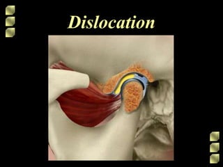 Dislocation
 