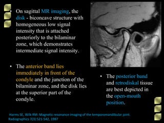 • On sagittal MR imaging, the
disk - biconcave structure with
homogeneous low signal
intensity that is attached
posteriorly to the bilaminar
zone, which demonstrates
intermediate signal intensity.
• The anterior band lies
immediately in front of the
condyle and the junction of the
bilaminar zone, and the disk lies
at the superior part of the
condyle.
Harms SE, Wilk RM: Magnetic resonance imaging of the temporomandibular joint.
Radiographics 7(3):521-542, 1987
• The posterior band
and retrodiskal tissue
are best depicted in
the open-mouth
position.
 