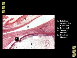 1. Primitive
articular disc
2. Upper cleft
3. Lower cleft
4. Temporal
blastema
5. Condylar
blastema
4
33
 